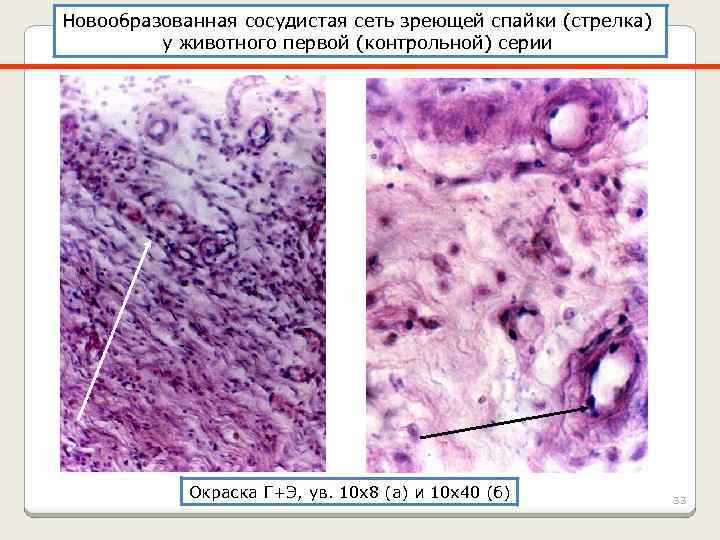 Новообразованная сосудистая сеть зреющей спайки (стрелка) у животного первой (контрольной) серии Окраска Г+Э, ув.