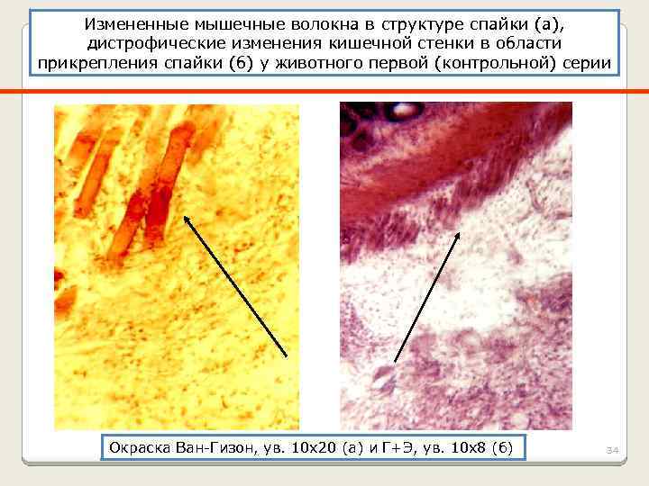 Измененные мышечные волокна в структуре спайки (а), дистрофические изменения кишечной стенки в области прикрепления