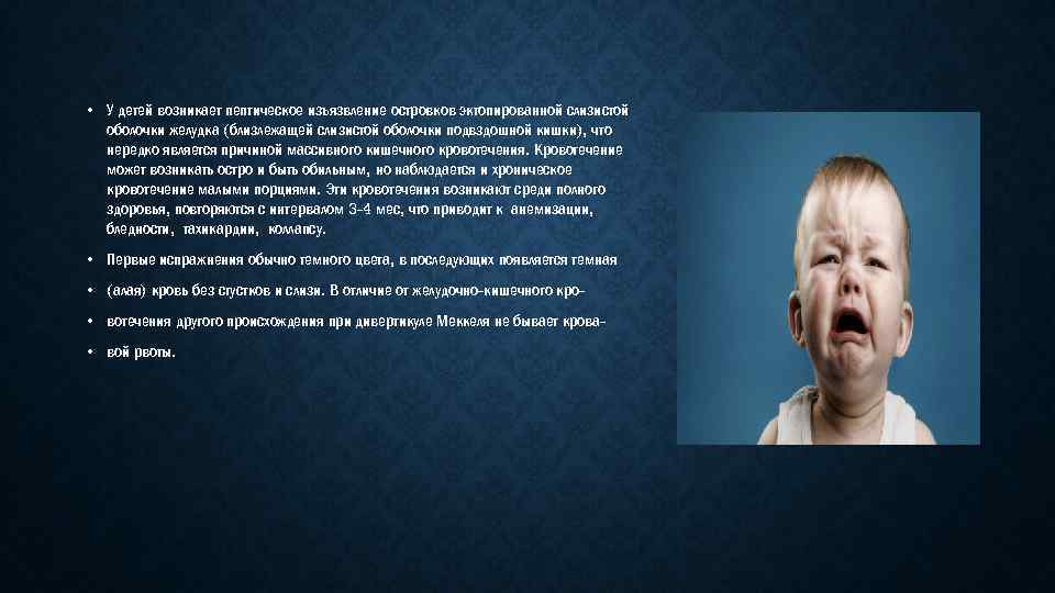  • У детей возникает пептическое изъязвление островков эктопированной слизистой оболочки желудка (близлежащей слизистой