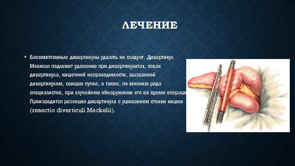 Дивертикул меккеля у детей презентация