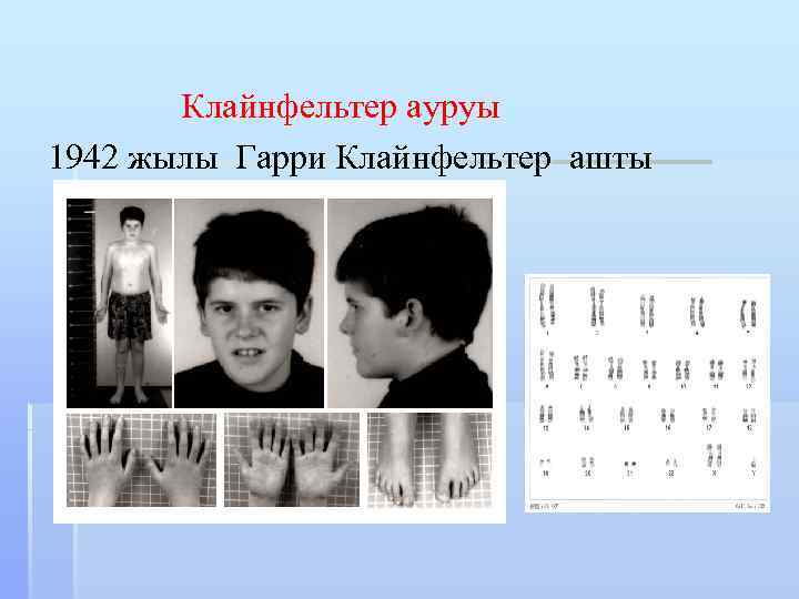 Клайнфельтер ауруы 1942 жылы Гарри Клайнфельтер ашты 