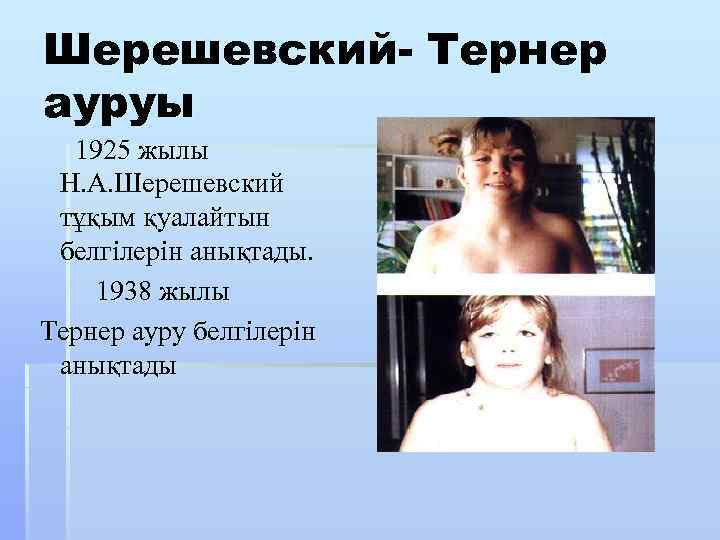 Шерешевский- Тернер ауруы 1925 жылы Н. А. Шерешевский тұқым қуалайтын белгілерін анықтады. 1938 жылы