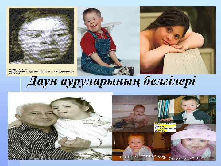 Даун ауруларының белгілері 