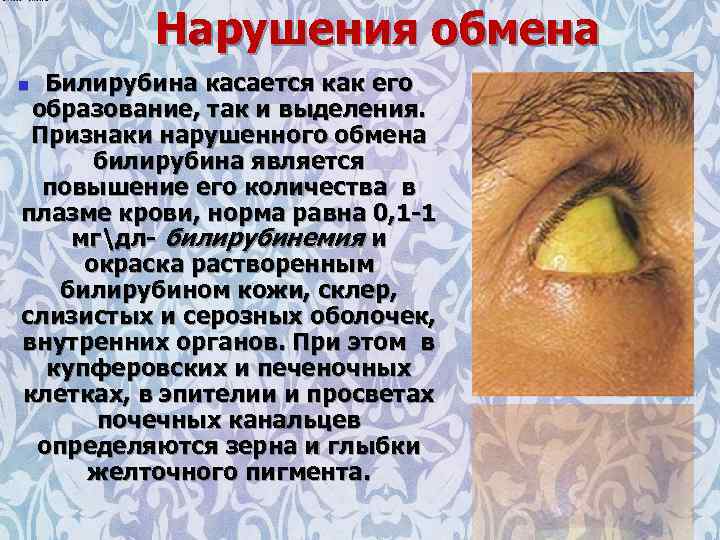 Нарушения обмена Билирубина касается как его образование, так и выделения. Признаки нарушенного обмена билирубина