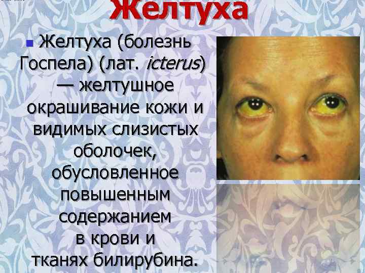 Желтуха (болезнь Госпела) (лат. icterus) — желтушное окрашивание кожи и видимых слизистых оболочек, обусловленное