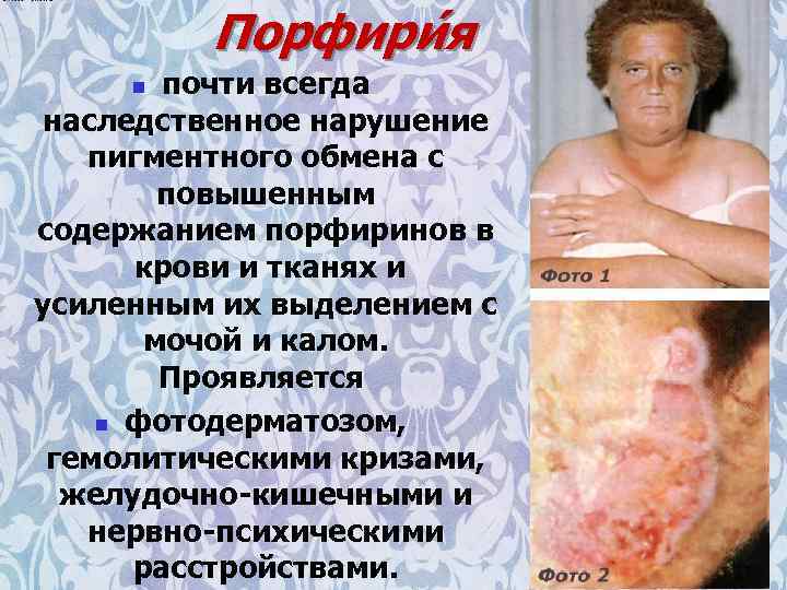 Порфири я почти всегда наследственное нарушение пигментного обмена с повышенным содержанием порфиринов в крови