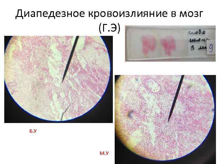 Диапедезное кровоизлияние в мозг (Г. Э) Б. У М. У 