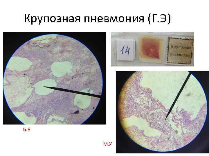 Крупозная пневмония (Г. Э) Б. У М. У 