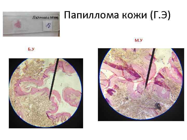 Папиллома кожи рисунок