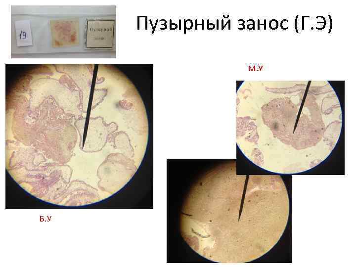 Пузырный занос (Г. Э) М. У Б. У 