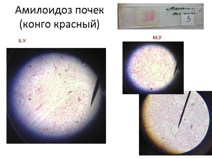 Амилоидоз почек (конго красный) Б. У М. У 