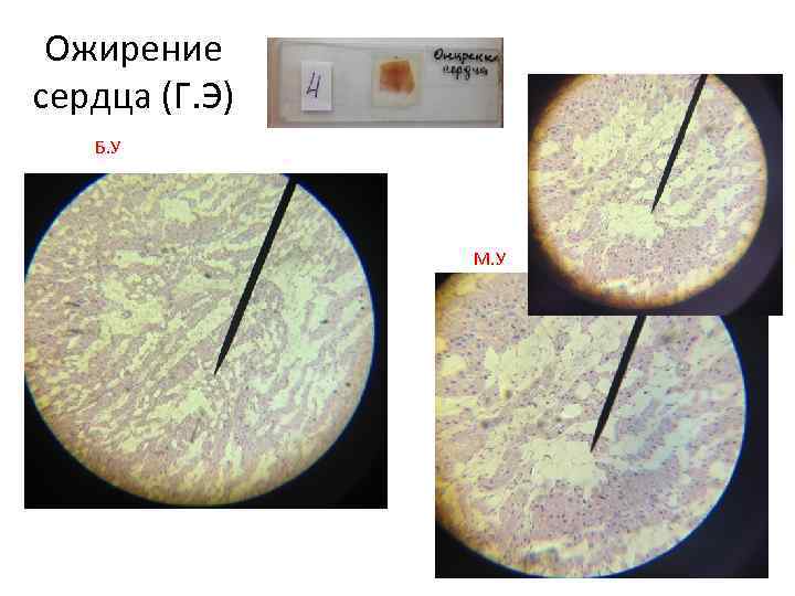 Ожирение сердца (Г. Э) Б. У М. У 