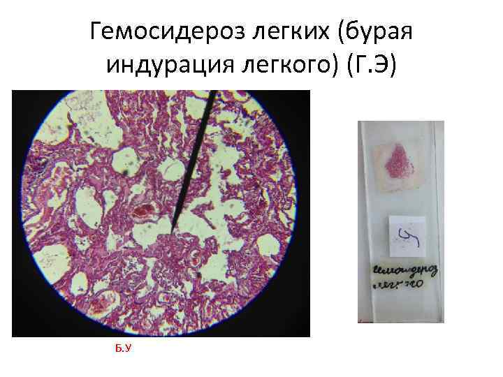 Гемосидероз легких (бурая индурация легкого) (Г. Э) Б. У 