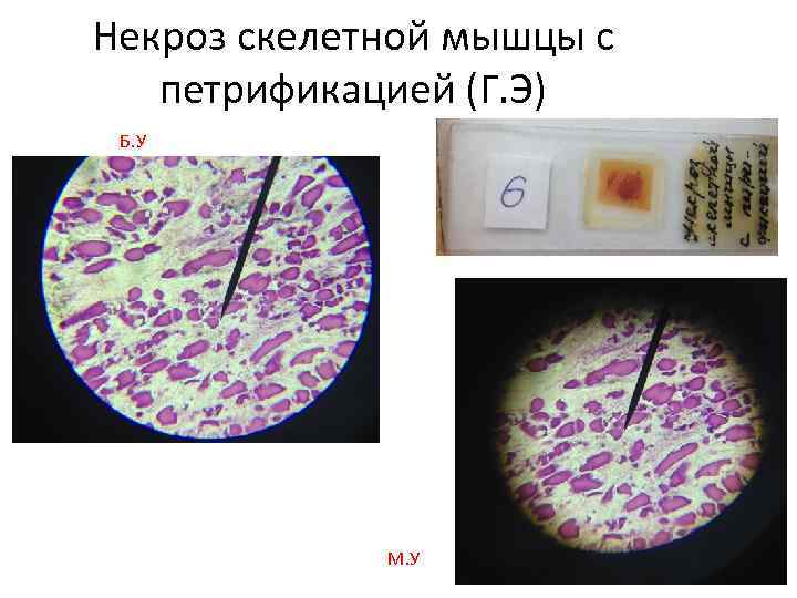 Некроз скелетной мышцы с петрификацией (Г. Э) Б. У М. У 