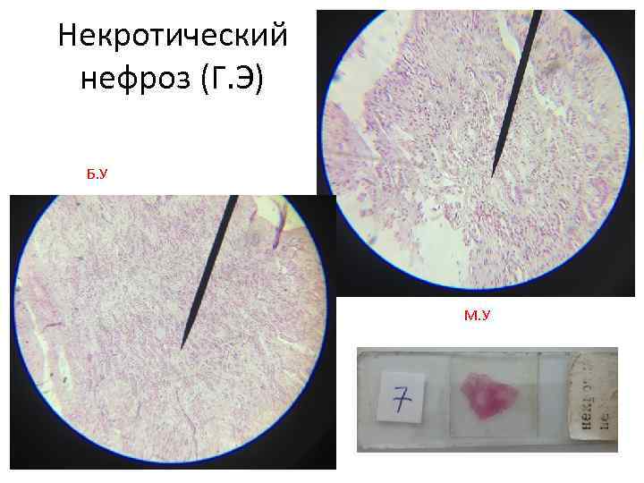 Некротический нефроз (Г. Э) Б. У М. У 