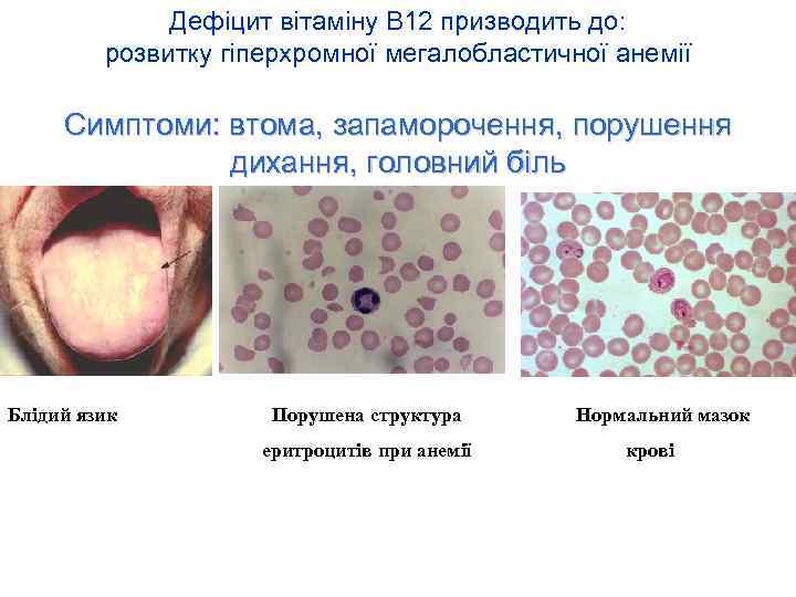 Дефіцит вітаміну В 12 призводить до: розвитку гіперхромної мегалобластичної анемії Симптоми: втома, запаморочення, порушення
