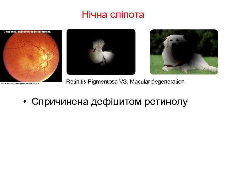 Нічна сліпота Retinitis Pigmentosa VS. Macular degeneration • Спричинена дефіцитом ретинолу 