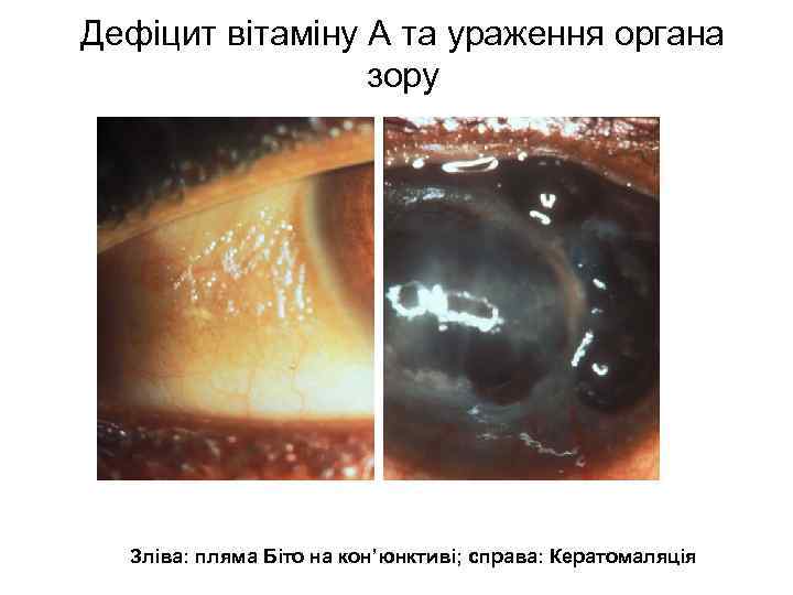 Дефіцит вітаміну А та ураження органа зору Зліва: пляма Біто на кон’юнктиві; справа: Кератомаляція