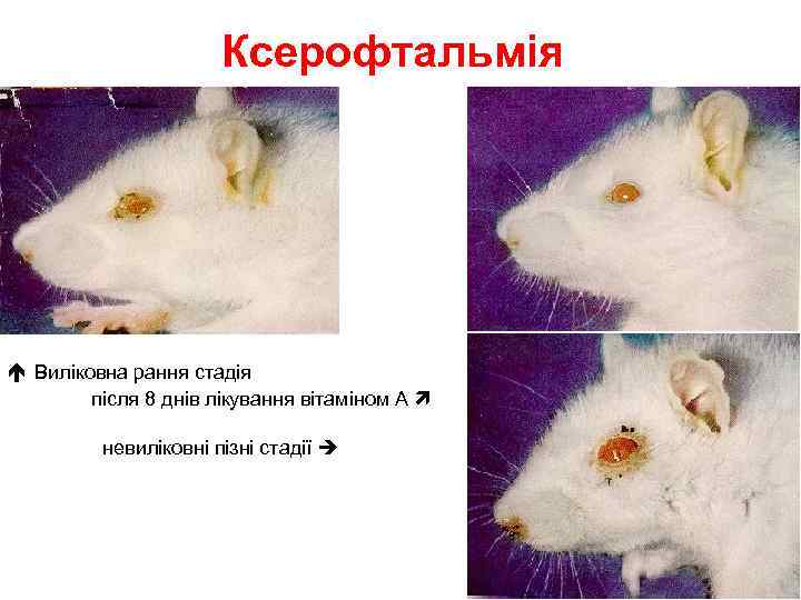 Ксерофтальмія Виліковна рання стадія після 8 днів лікування вітаміном А невиліковні пізні стадії 