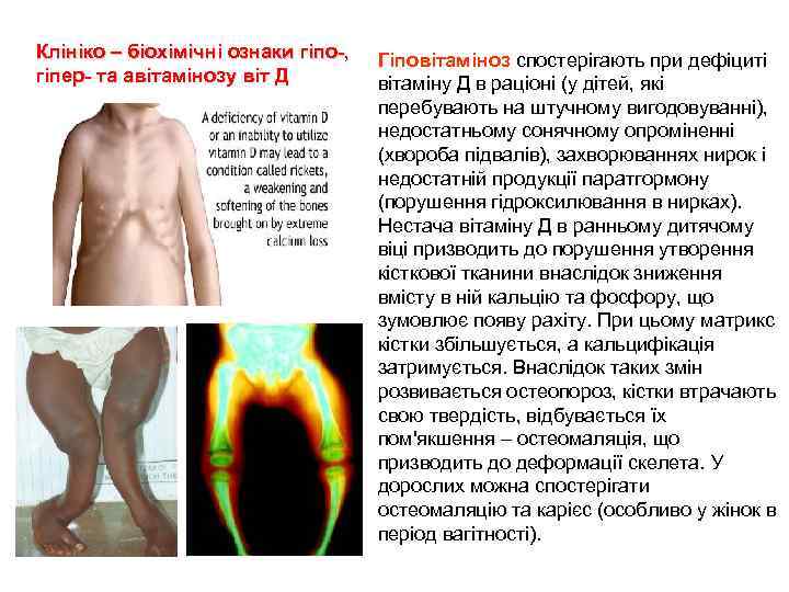 Клініко – біохімічні ознаки гіпо-, гіпер- та авітамінозу віт Д Гіповітаміноз спостерігають при дефіциті