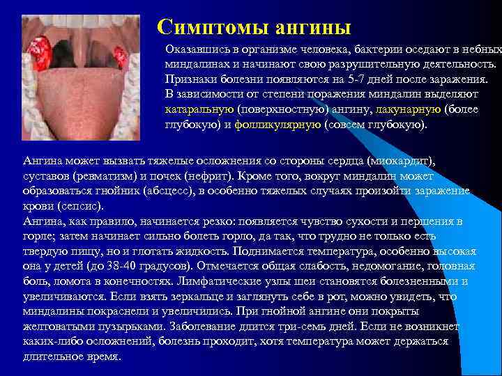 Симптомы ангины Оказавшись в организме человека, бактерии оседают в небных миндалинах и начинают свою