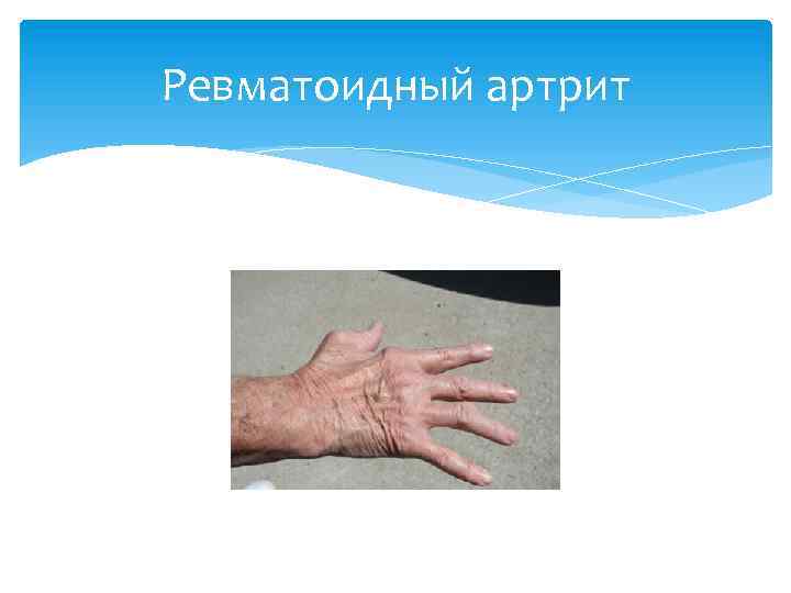 Ревматоидный артрит 