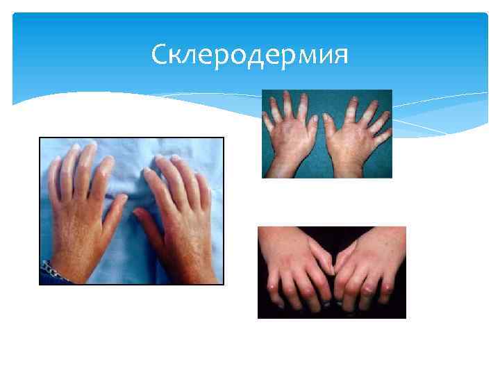 Склеродермия 