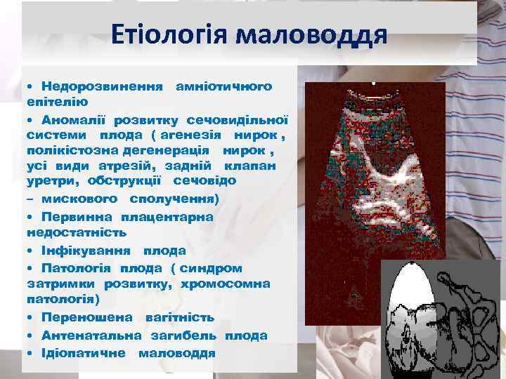 Етіологія маловоддя • Недорозвинення амніотичного епітелію • Аномалії розвитку сечовидільної системи плода ( агенезія