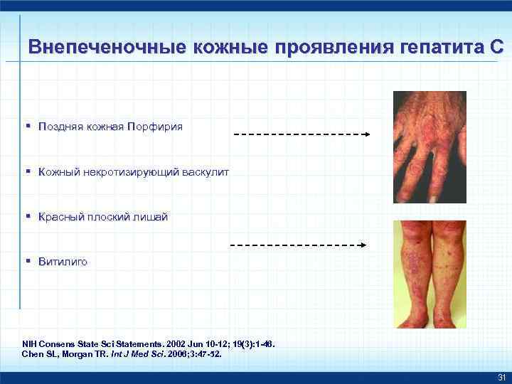 Внепеченочные кожные проявления гепатита С § Поздняя кожная Порфирия § Кожный некротизирующий васкулит §