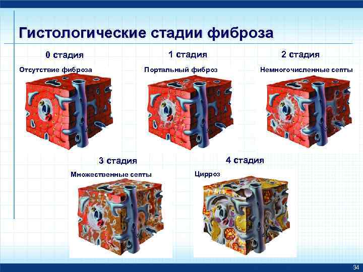 Гистологические стадии фиброза 1 стадия 0 стадия Отсутствие фиброза Портальный фиброз Немногочисленные септы 4