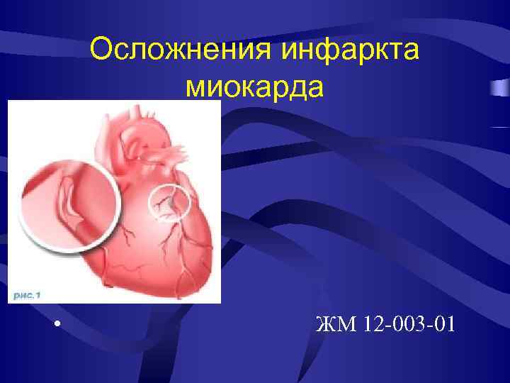 Осложнения инфаркта миокарда • ЖМ 12 -003 -01 