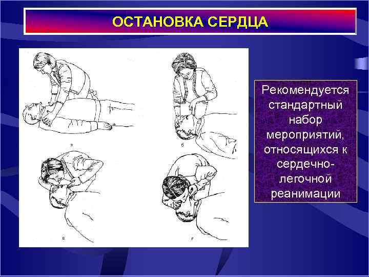 ОСТАНОВКА СЕРДЦА Рекомендуется стандартный набор мероприятий, относящихся к сердечнолегочной реанимации 