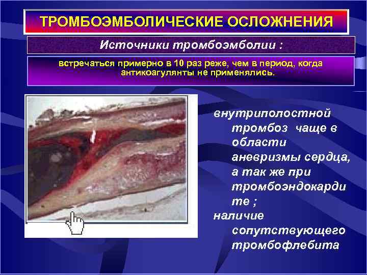 ТРОМБОЭМБОЛИЧЕСКИЕ ОСЛОЖНЕНИЯ Источники тромбоэмболии : встречаться примерно в 10 раз реже, чем в период,