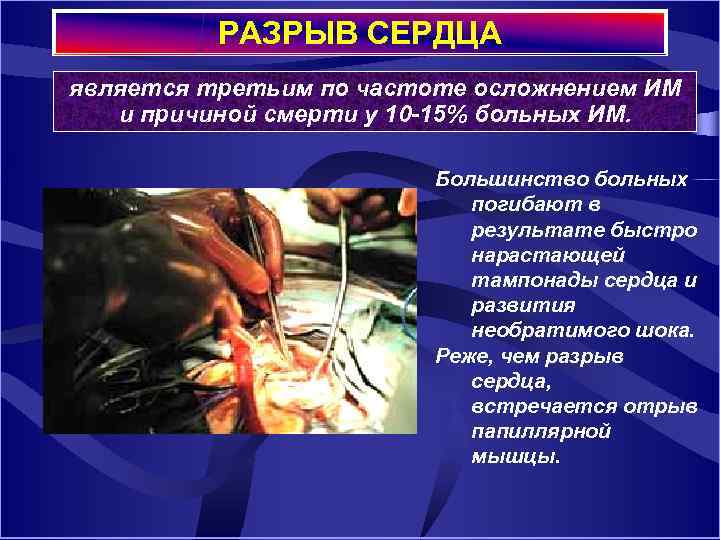 РАЗРЫВ СЕРДЦА является третьим по частоте осложнением ИМ и причиной смерти у 10 -15%