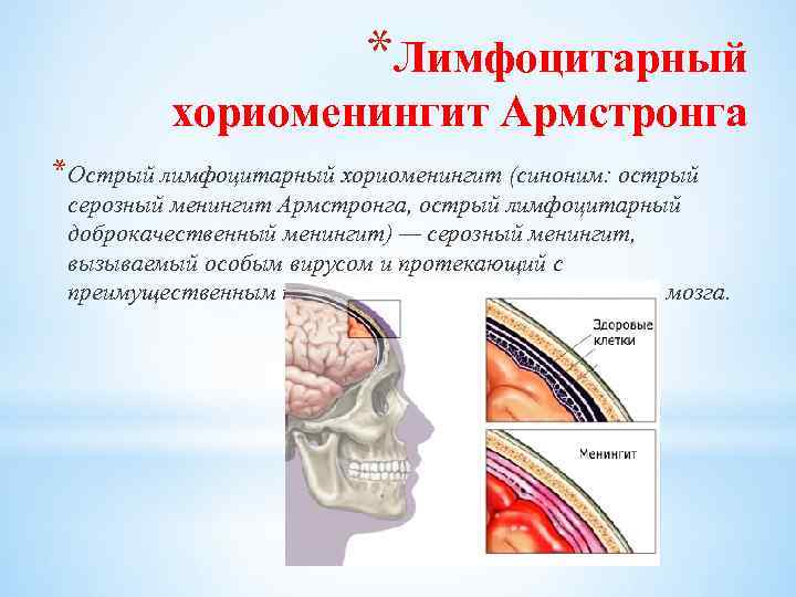 *Лимфоцитарный хориоменингит Армстронга *Острый лимфоцитарный хориоменингит (синоним: острый серозный менингит Армстронга, острый лимфоцитарный доброкачественный