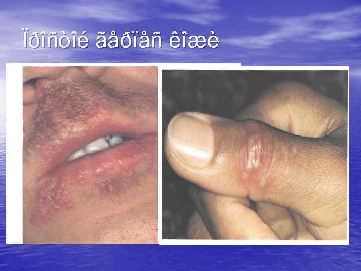 Ïðîñòîé ãåðïåñ êîæè 