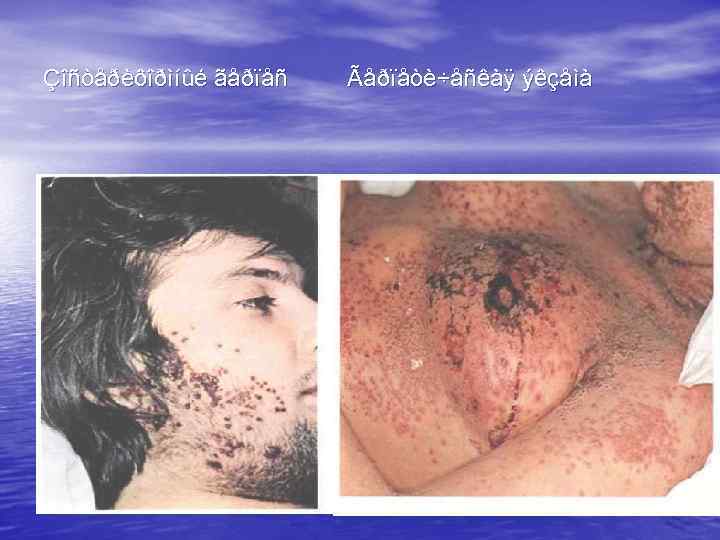 Çîñòåðèôîðìíûé ãåðïåñ Ãåðïåòè÷åñêàÿ ýêçåìà 