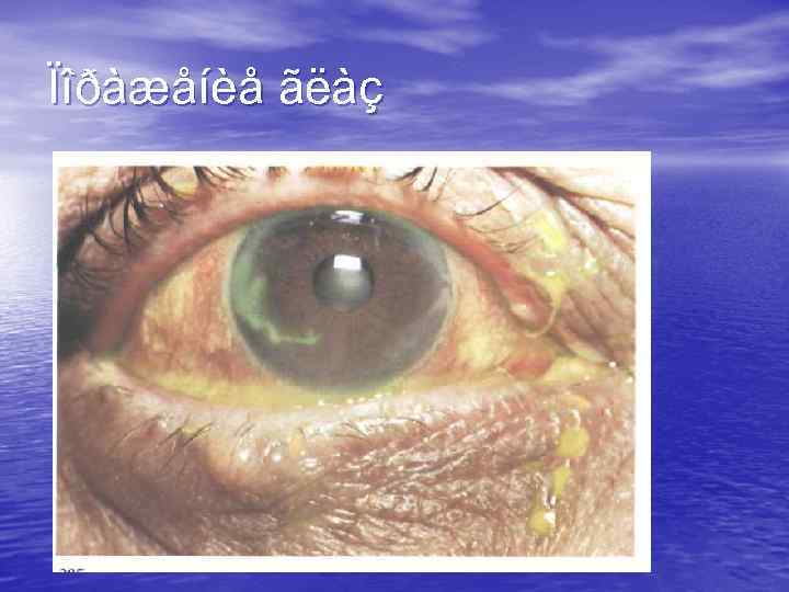 Ïîðàæåíèå ãëàç 
