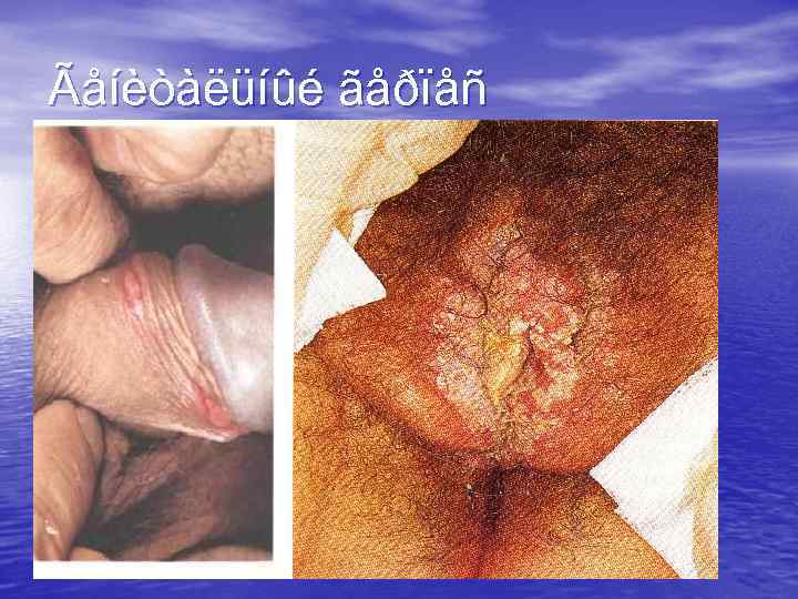 Ãåíèòàëüíûé ãåðïåñ 