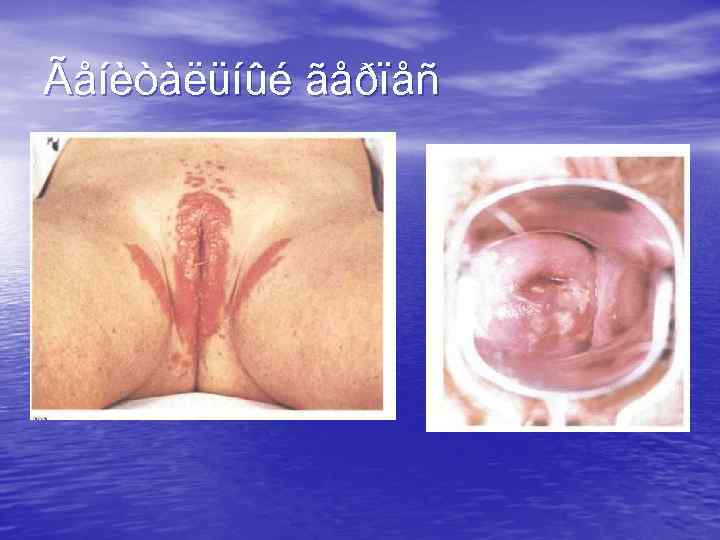 Ãåíèòàëüíûé ãåðïåñ 