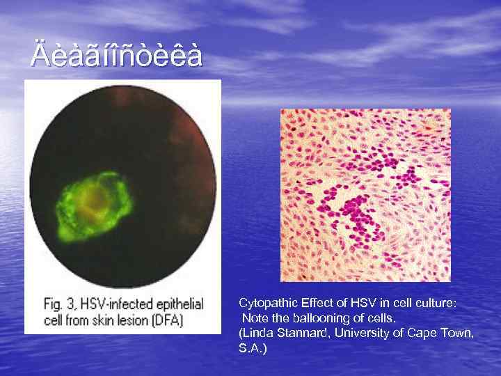 Äèàãíîñòèêà Cytopathic Effect of HSV in cell culture: Note the ballooning of cells. (Linda
