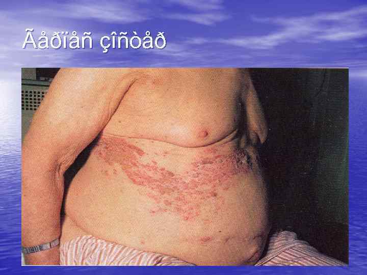 Ãåðïåñ çîñòåð 