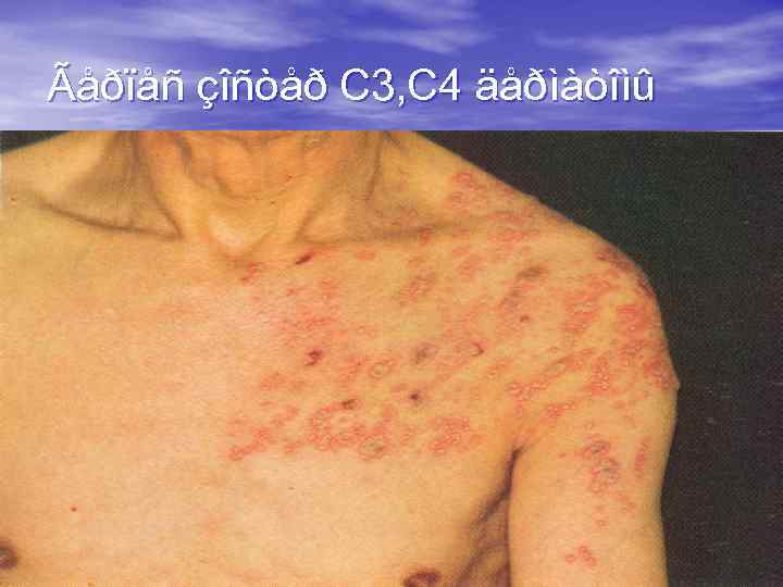 Ãåðïåñ çîñòåð C 3, C 4 äåðìàòîìû 