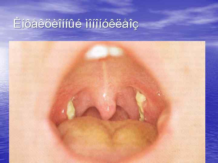 Èíôåêöèîííûé ìîíîíóêëåîç 