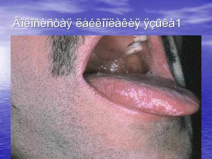  îëîñèñòàÿ ëåéêîïëàêèÿ ÿçûêà 1 