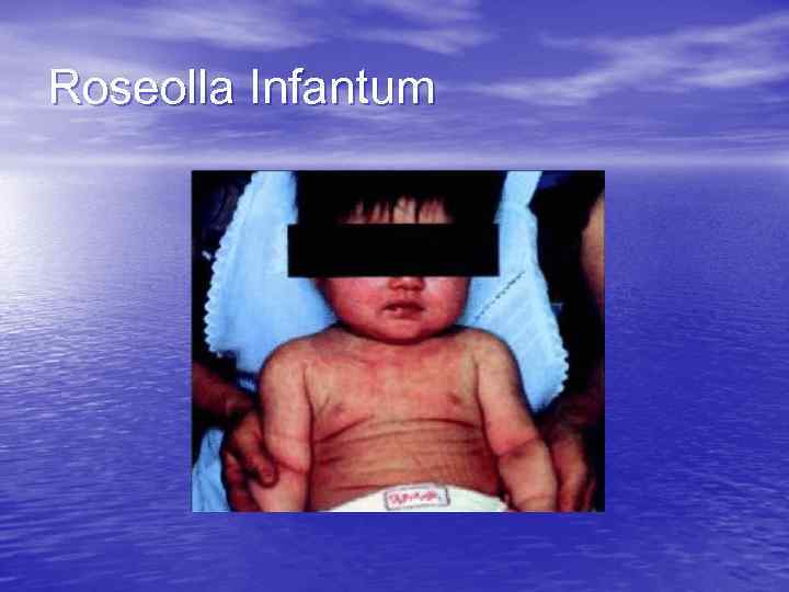 Roseolla Infantum 