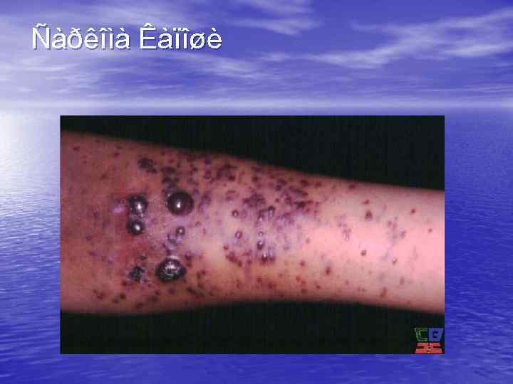 Ñàðêîìà Êàïîøè 