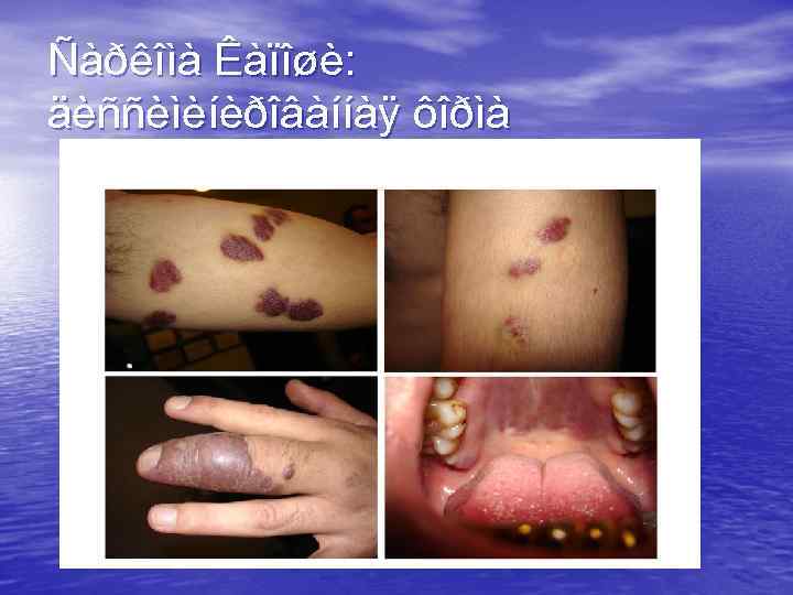 Ñàðêîìà Êàïîøè: äèññèìèíèðîâàííàÿ ôîðìà 