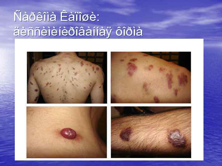 Ñàðêîìà Êàïîøè: äèññèìèíèðîâàííàÿ ôîðìà 