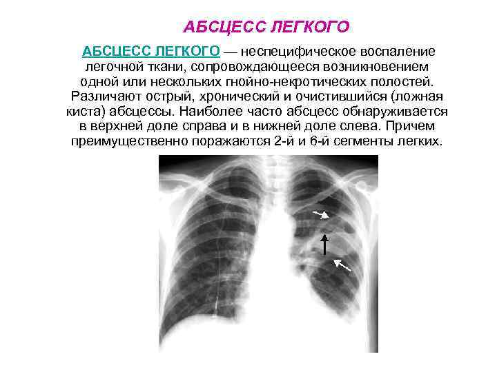 АБСЦЕСС ЛЕГКОГО — неспецифическое воспаление легочной ткани, сопровождающееся возникновением одной или нескольких гнойно-некротических полостей.